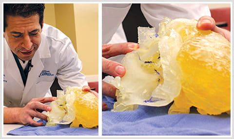 David Morales, MD, looks at a 3D model of Damon's heart to prepare for open heart surgery. David Morales, MD, looks at a 3D model of Damon's heart to prepare for open heart surgery.